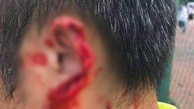 Çin’de akılalmaz olay! Rakibinin kulağını kopardı...
