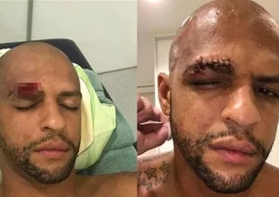 Felipe Melo'ya nazar değdi!
