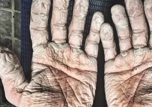 Dünya rekoru kırdı ama elleri bu hale geldi!